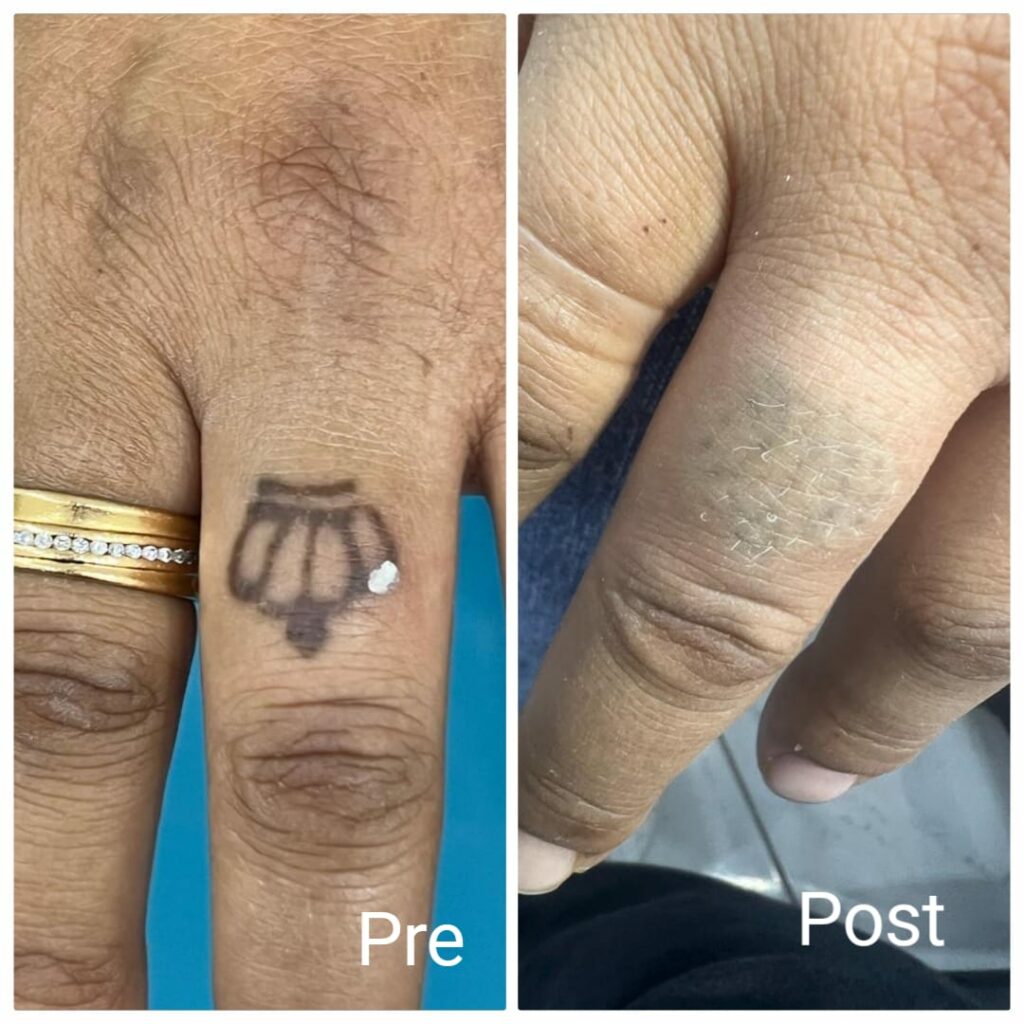 نتيجة بعد جلسة واحد ليزر كيوسويتشد في الغردقة